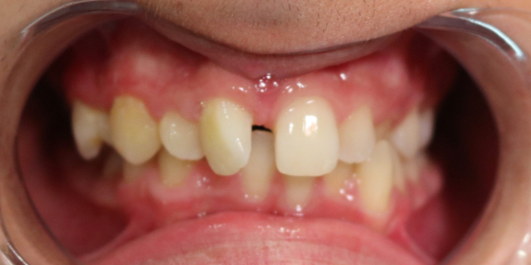 Before-Ortodontia