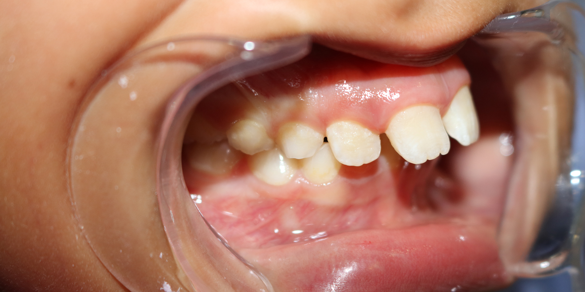 Before-Ortodontia removível